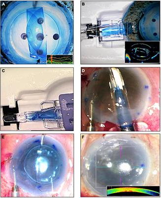 “Endothelium-Out” and “Endothelium-In” Descemet Membrane Endothelial Keratoplasty (DMEK) Graft Insertion Techniques: A Systematic Review With Meta-Analysis